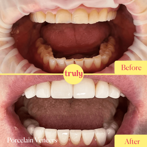 Porcelain veneers