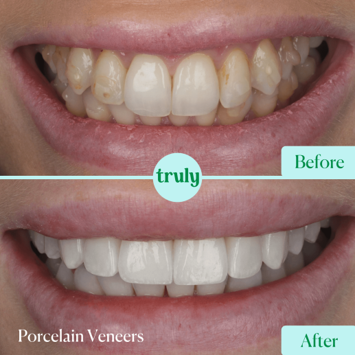 Porcelain veneers