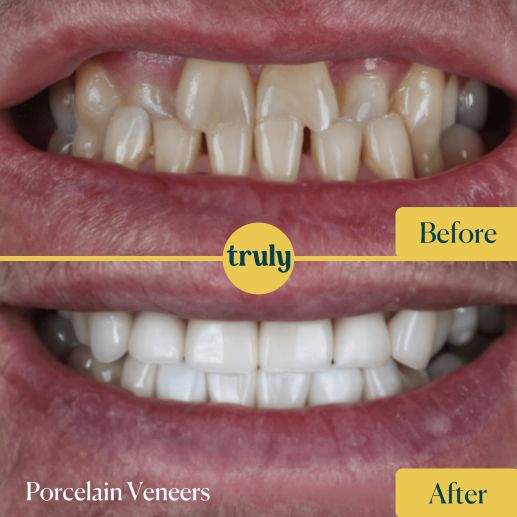 Porcelain veneers
