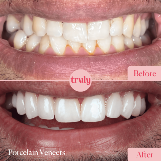 Porcelain veneers