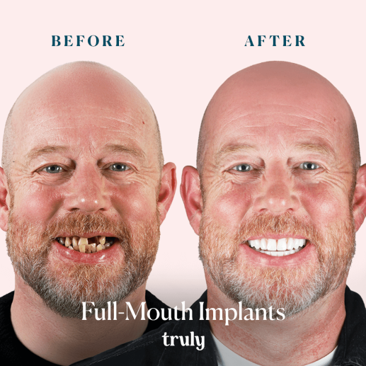 Implants