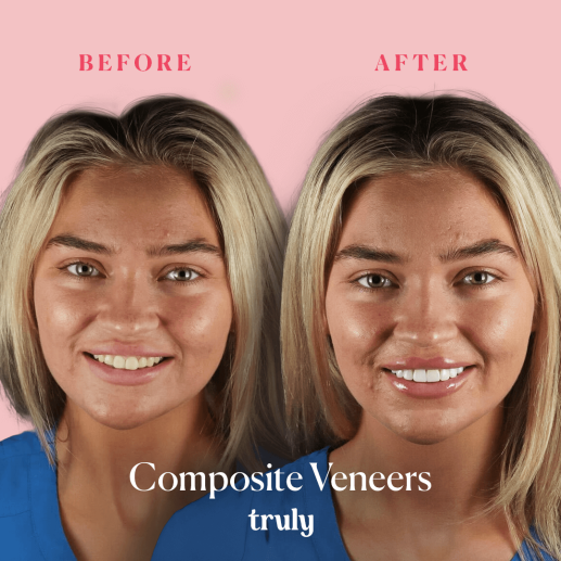 Veneers