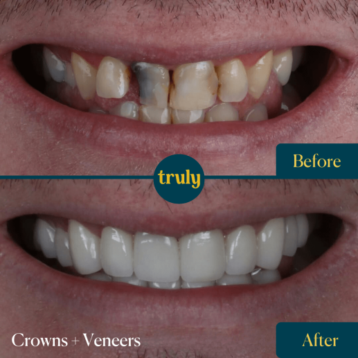 Crowns and Veneers