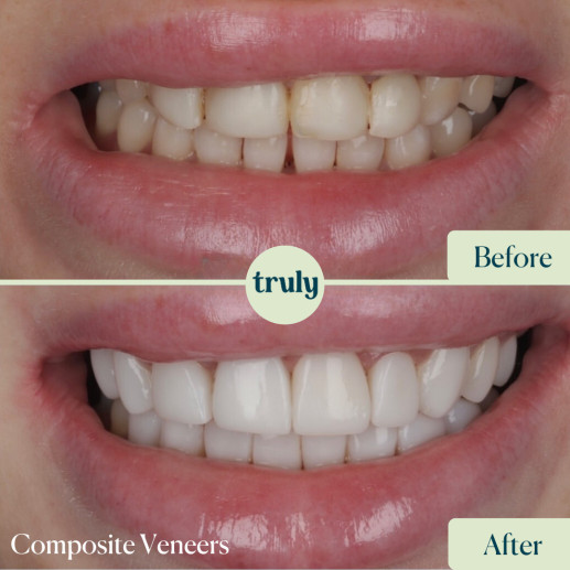Composite Bondin