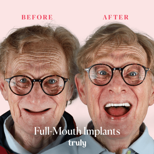 Implants