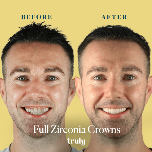 Crowns